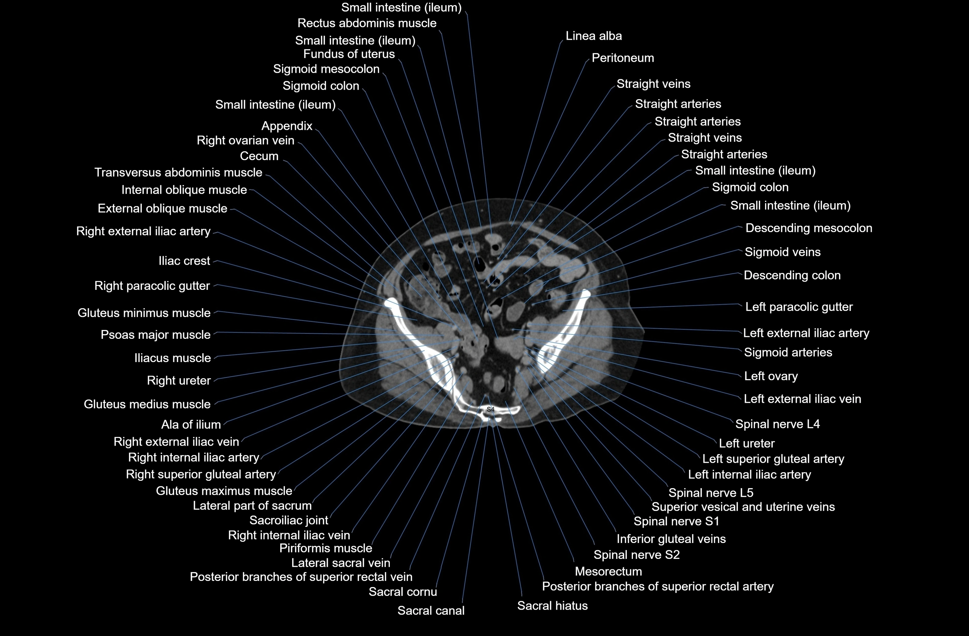 CT Abdomen axial cross sectional anatomy labelled radiology image-00075.webp